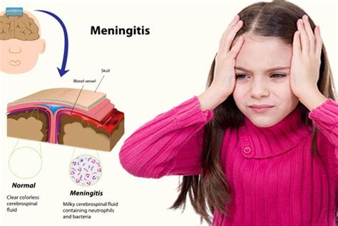 meningitis in children cdc